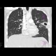 Lung tuberculosis, cavern, endobronchial spread, tree-in-bud: CT - Computed tomography